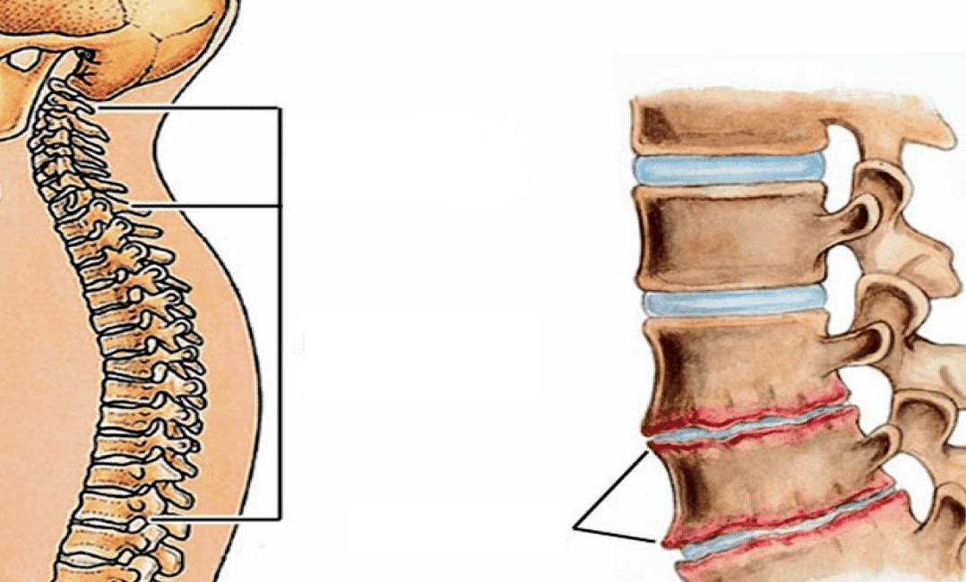 Hoe ziet osteochondrose van de wervelkolom eruit