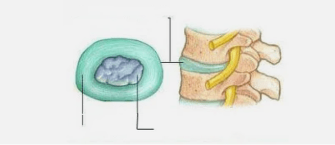 Aard van osteochondrose