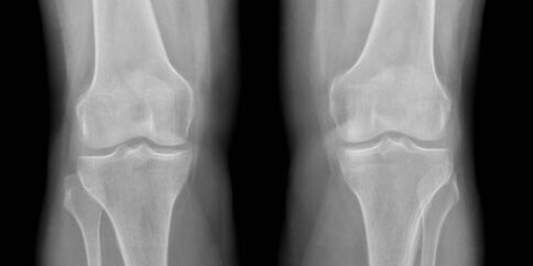 artrose van de knie op röntgenfoto